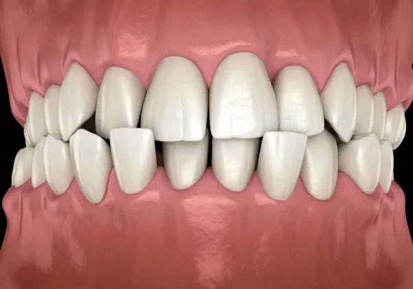 Các loại khớp cắn: 7 dạng thường gặp và những điều bạn không nên bỏ qua