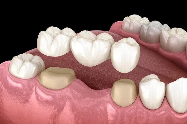 Kỹ thuật phục hình răng là gì? Tổng quan các phương pháp phục hình răng hiện đại
